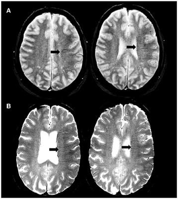 Does the Brush-Sign Reflect Collateral Status and DWI-ASPECTS in Large Vessel Occlusion?